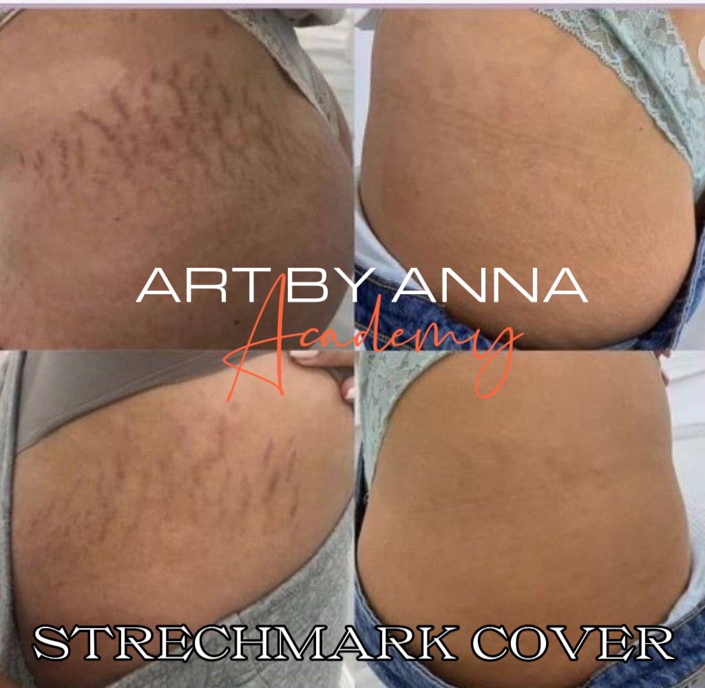 Stretchmark Camouflage