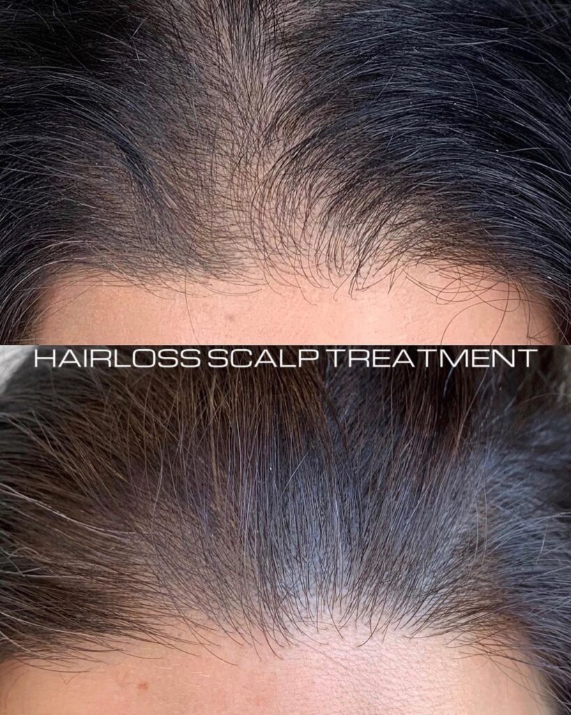Hair Loss Camouflage