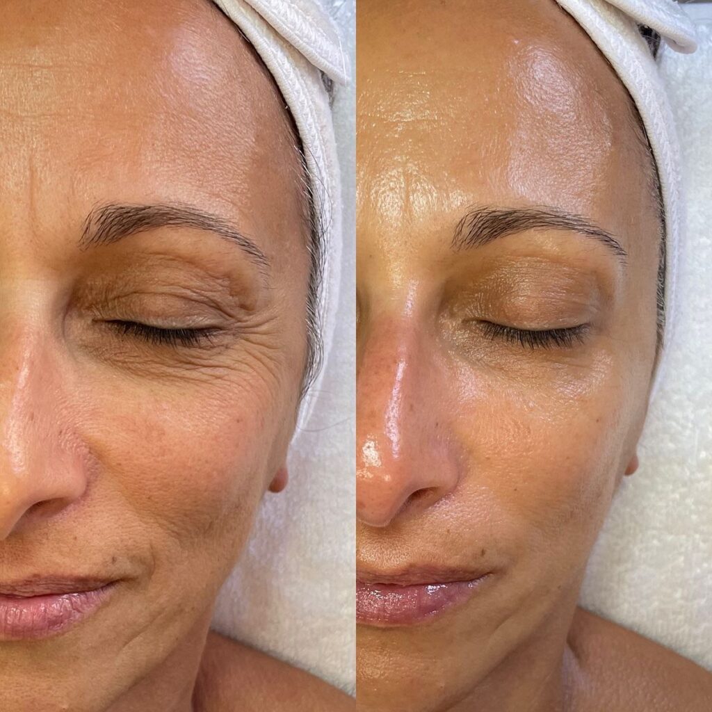 Korean Facial Treatment